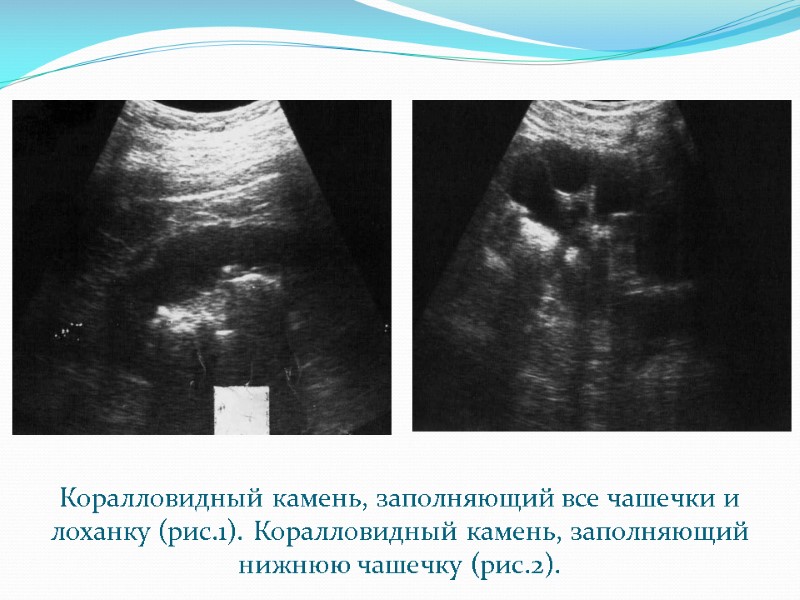 Коралловидный камень, заполняющий все чашечки и лоханку (рис.1). Коралловидный камень, заполняющий нижнюю чашечку (рис.2).